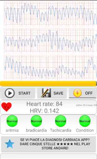 Diagnosi cardiaca (aritmia) 3