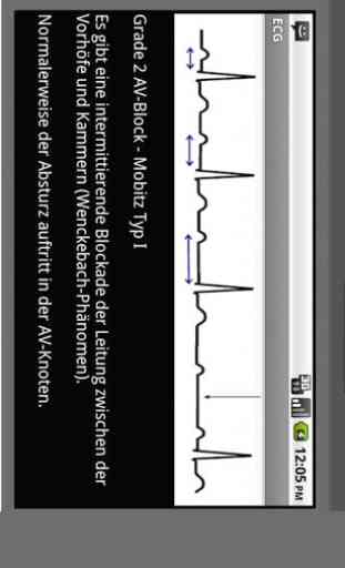 Elektrokardiogramm EKG Typen 3