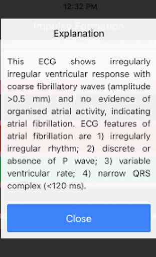 ECG Master: Electrocardiogram Quiz & Explanation 4