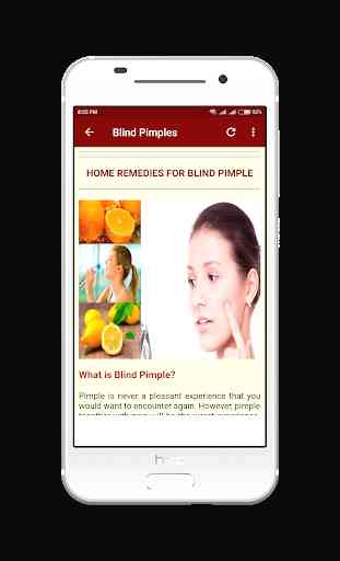 Acne & Pimples (Home Care) 3