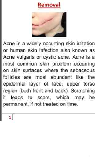 Acne Scar Removal 2