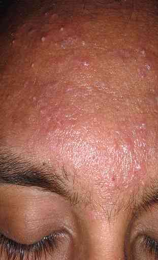 hormonal acne treatment 2