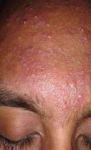 hormonal acne treatment 4