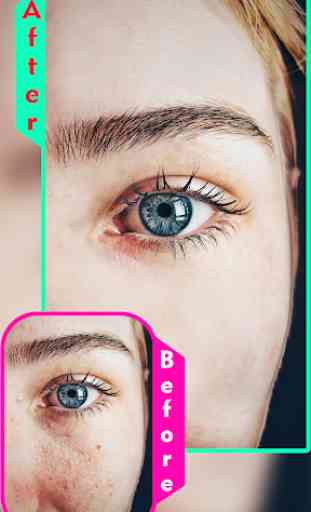 Pimple Remover : Beauty Effects 2