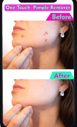 Pimple Remover : Beauty Effects 3