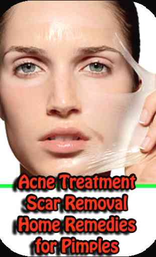 Remedies for Pimples, Acne Treatment, Scar Removal 1