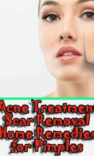 Remedies for Pimples, Acne Treatment, Scar Removal 2