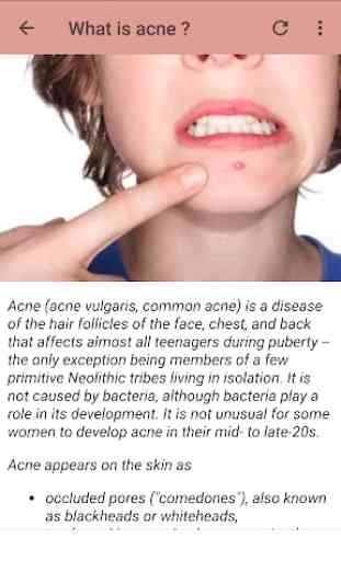 Trattamento per l'acne 2