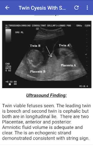 Ultrasound Guide A2Z 1