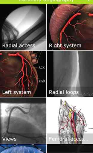 Coronary angiography 1