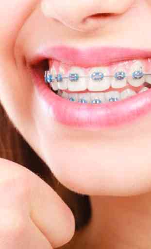 Denti Real Braces 1
