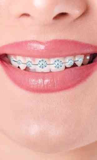 Denti Real Braces 2