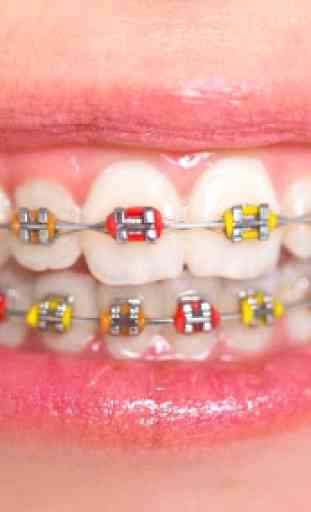 Denti Real Braces 4