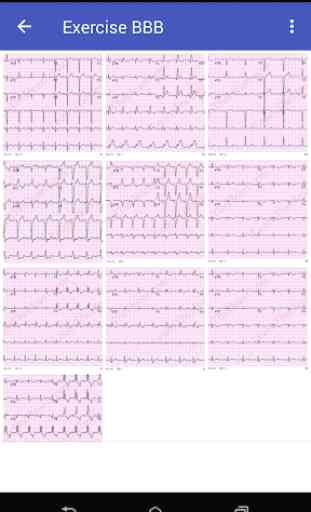 Learn How To Read ECG 4