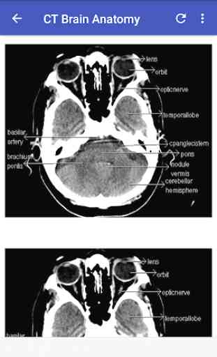 CT Brain Interpretation 2