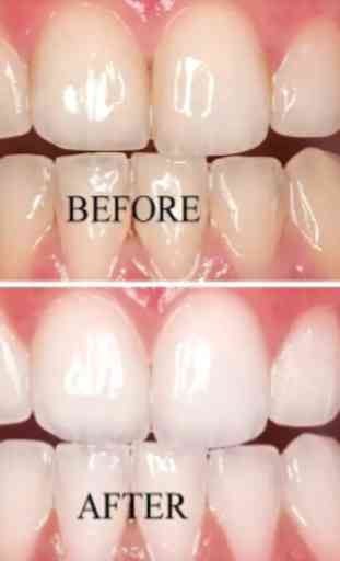 teeth whitening naturally tips 2