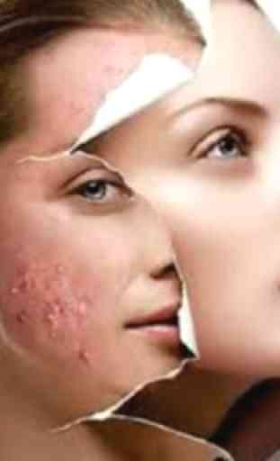 Acne Scars Remedies 2