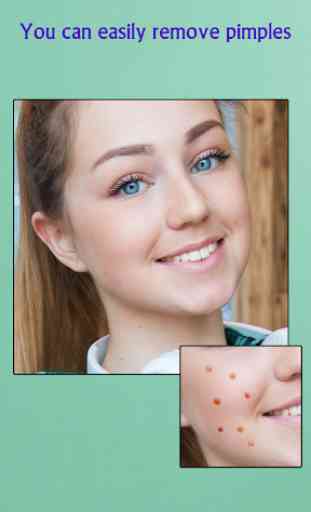 Remove Acne from Face 4