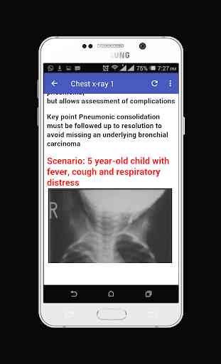 Chest X-ray Easy Learning 1