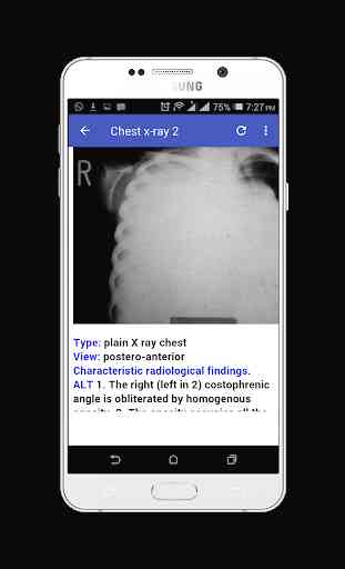 Chest X-ray Easy Learning 4