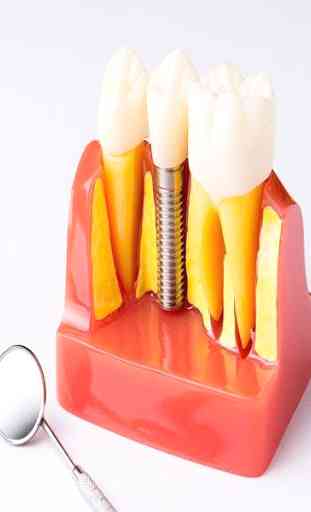 Impianti dentali 1