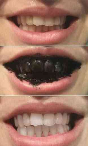 Teeth Whitening Tips 2