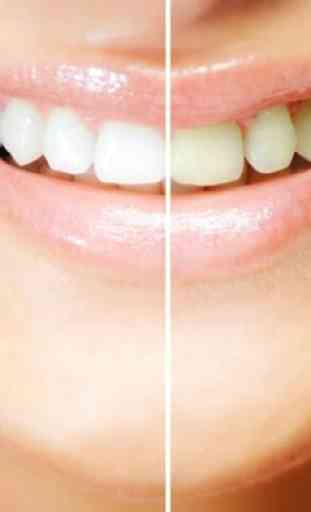Teeth whitening Tips 2