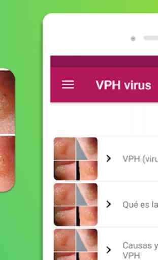 VPH virus síntomas tratamiento y prevención 3