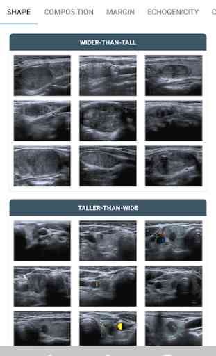 Thyroid Nodules - Ultrasound Guide 2
