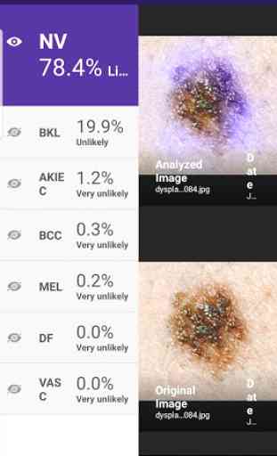 Visus: Skin Cancer Detection 2