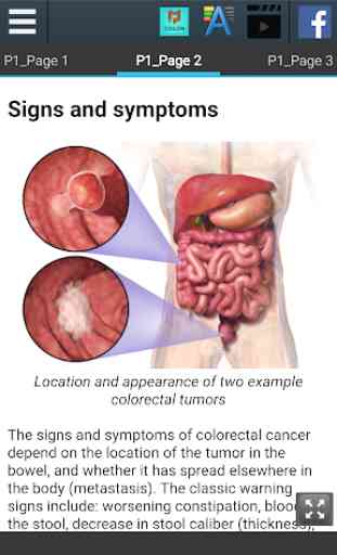 Colon Cancer Info 3