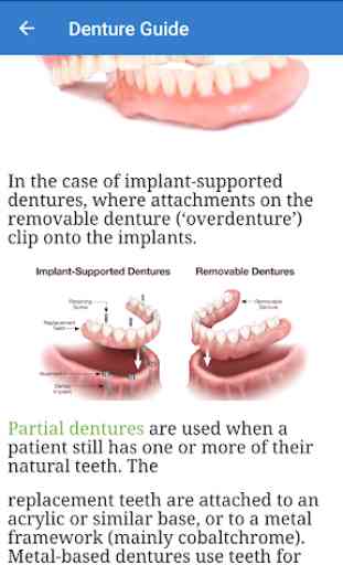 Dentures guide: Types, Crowns, implants, cleaning 4