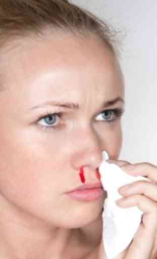 Nose Bleeding Remedies 1