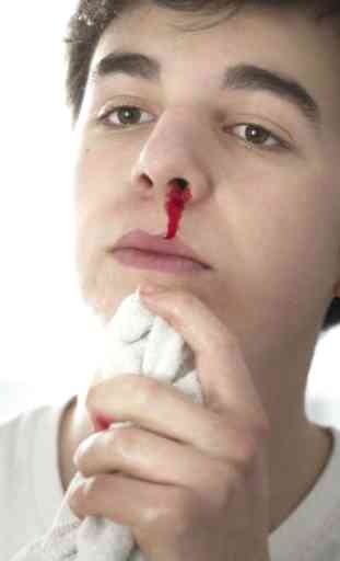 Nose Bleeding Remedies 2