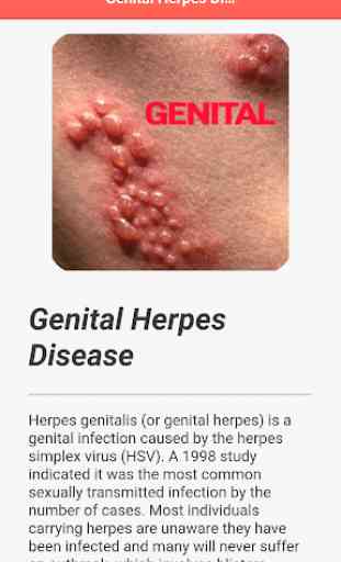 Genital Herpes 3