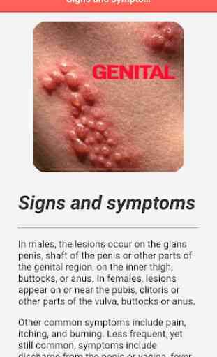 Genital Herpes 4