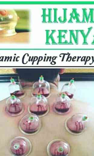 Cupping Therapy 1
