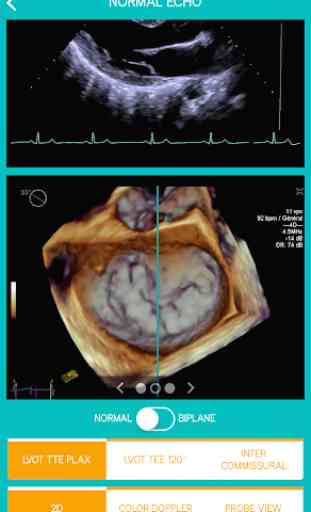 Mitral View 4
